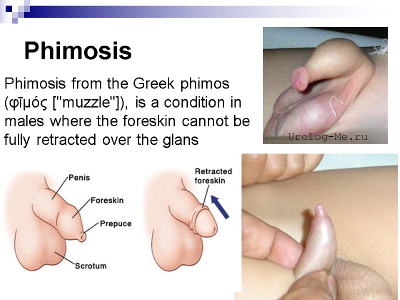 Phimosis Phimosis from the Greek phimos (φῑμός [